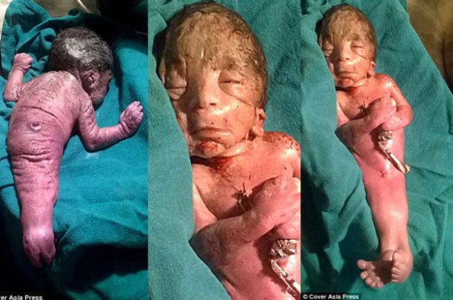 Hindistan'da deniz kızı sendromlu bebek doğdu!