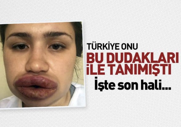 Türkiye onu dudaklarıyla tanımıştı! İşte son hali